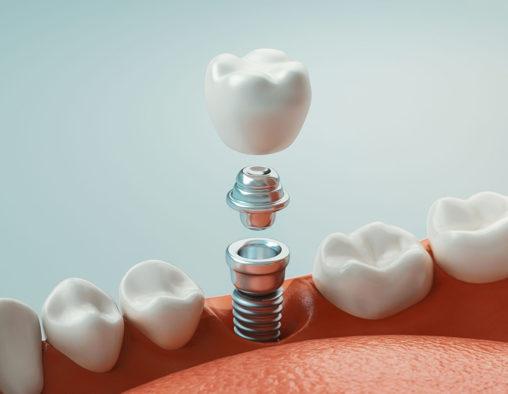 Illustration of a dental implant procedure showing the implant components and the surrounding teeth in the mouth.