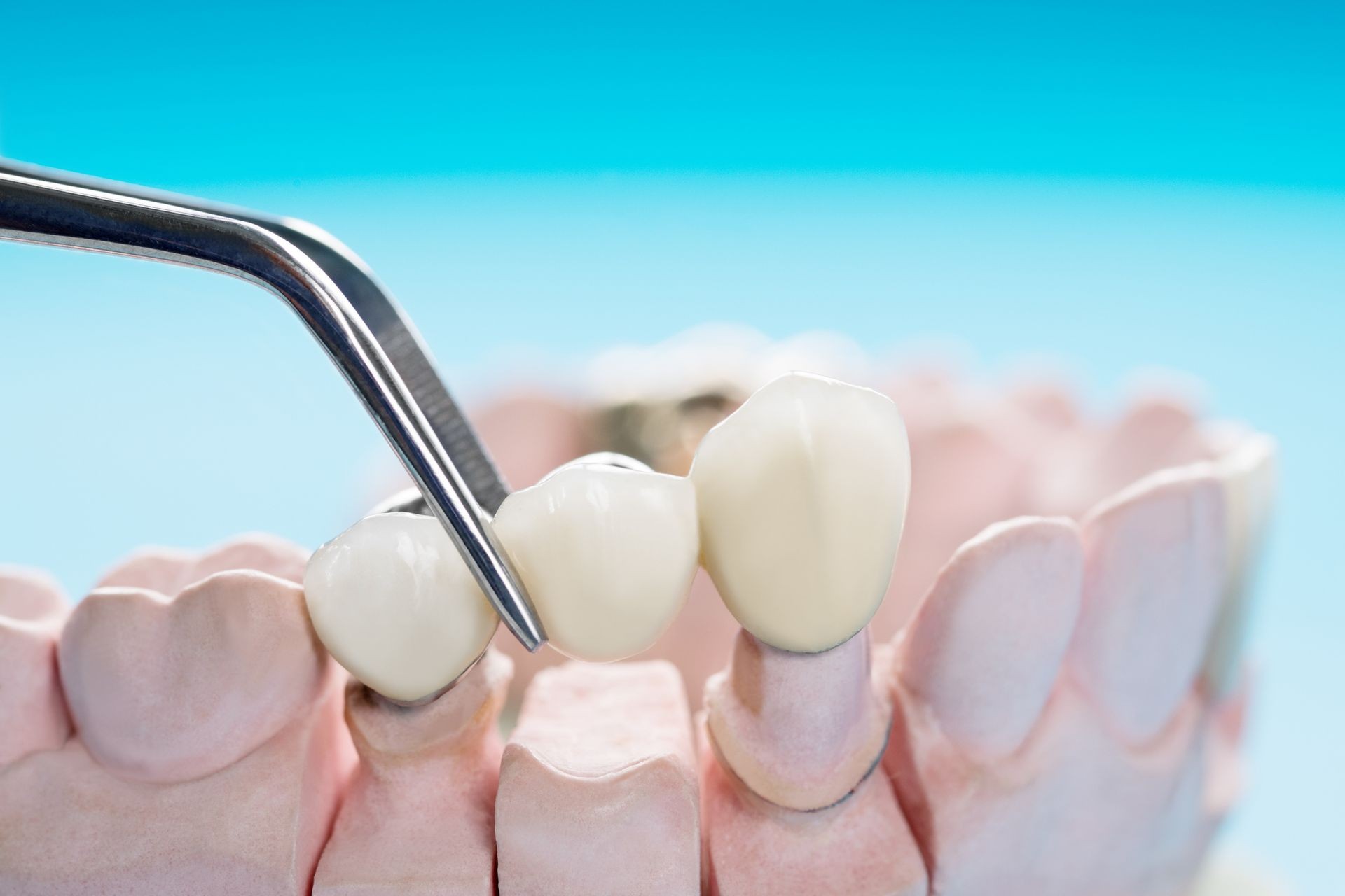 Close-up of dental model showing dental bridge being placed with tweezers on prepared teeth.